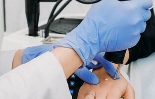 spôsoby odstránenia bradavíc