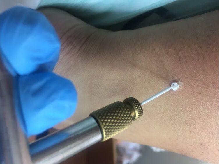 spôsoby odstránenia bradavíc