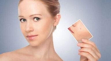 prehľad účinných liekov na bradavice a papilómy