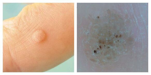 Bežné bradavice počas vyšetrenia a dermatoskopia