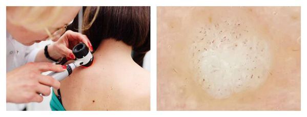 Dermatoskopia bradavice