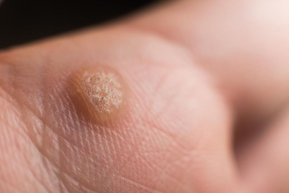 ľudský papilomavírus na koži